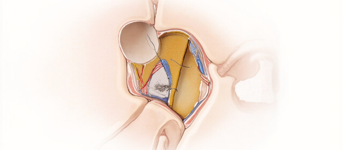 Le canal de Volkmann : structure, fonction et importance dans l'anatomie osseuse