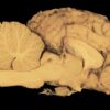 Le cervelet : anatomie, fonctions et pathologies de cette structure cérébrale essentielle
