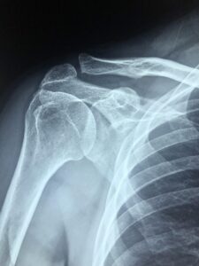 Le col anatomique de l'humérus : structure, fonction et pathologies