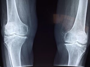 Le condyle fémoral médial : anatomie, fonction et pathologies
