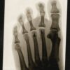 Le cuboïde : anatomie complète, fonctions et pathologies de cet os du pied