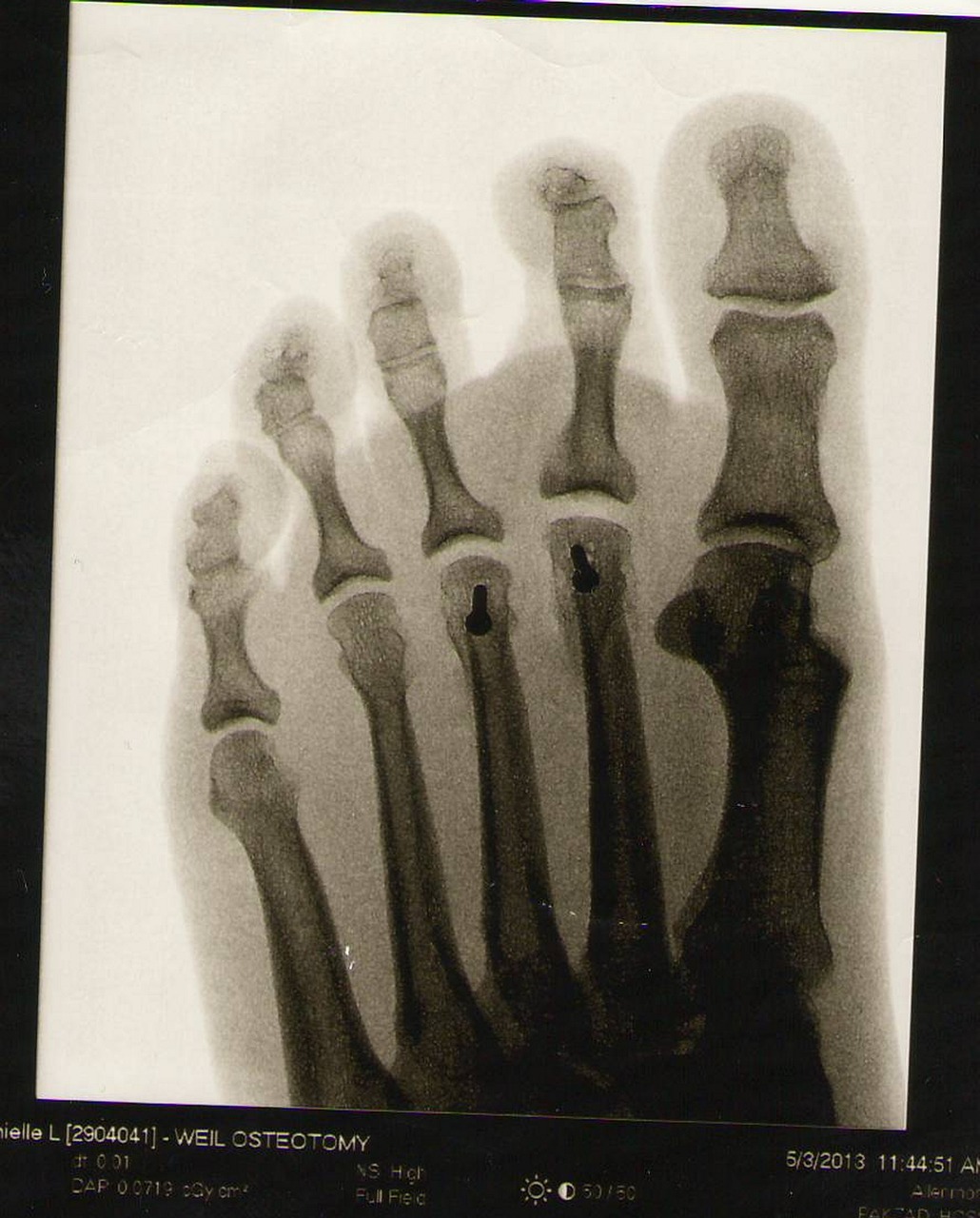 Le cuboïde : anatomie complète, fonctions et pathologies de cet os du pied