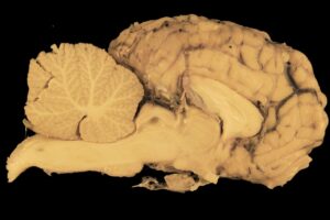 Le culmen : anatomie, fonctions et pathologies du sommet du cervelet