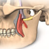Le ganglion otique : anatomie, fonction et pathologies associées