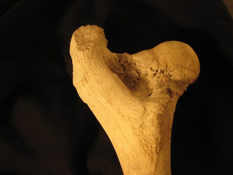 Le Petit Trochanter : Anatomie, Fonctions et Pathologies