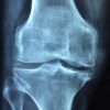 Le tendon du quadriceps : anatomie, fonction et pathologies