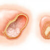 Le tube neural : formation, anatomie et malformations