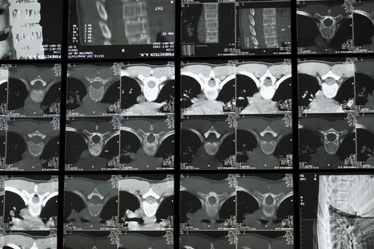 L&rsquo;espace épidural : anatomie, fonctions et applications cliniques