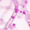 Leucémie prolymphocytaire : symptômes, diagnostic et traitements