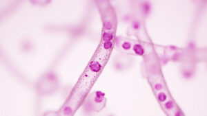Leucémie prolymphocytaire : symptômes, diagnostic et traitements