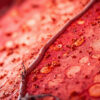 L&rsquo;hémosidérose pulmonaire : causes, symptômes, diagnostic et traitement