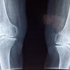 Luxation de la rotule : causes, symptômes, diagnostic et traitement