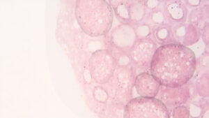 Lymphome T : comprendre cette forme rare de cancer du sang