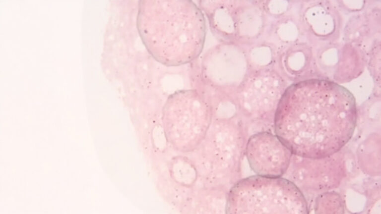 Lymphome T : comprendre cette forme rare de cancer du sang