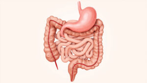 Maladie de Crohn : symptômes, causes, diagnostic et traitements