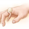Maladie de Dupuytren : causes, symptômes, diagnostic et traitements