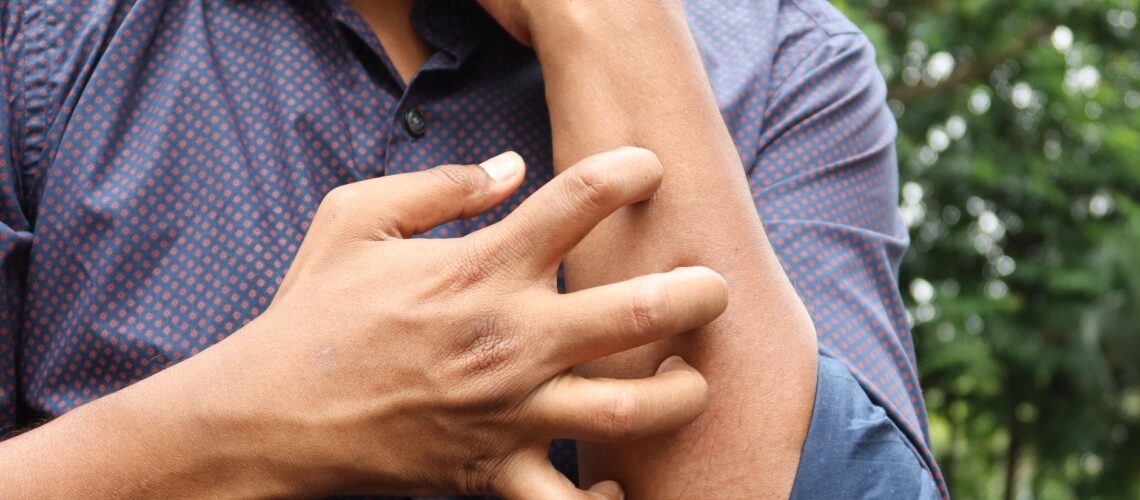 A man in a blue shirt scratching his arm outdoors, highlighting skin irritation.