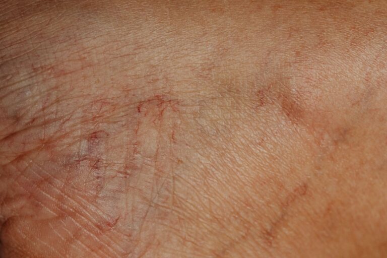 Perte d&rsquo;élasticité : comment diagnostiquer ce signe du vieillissement