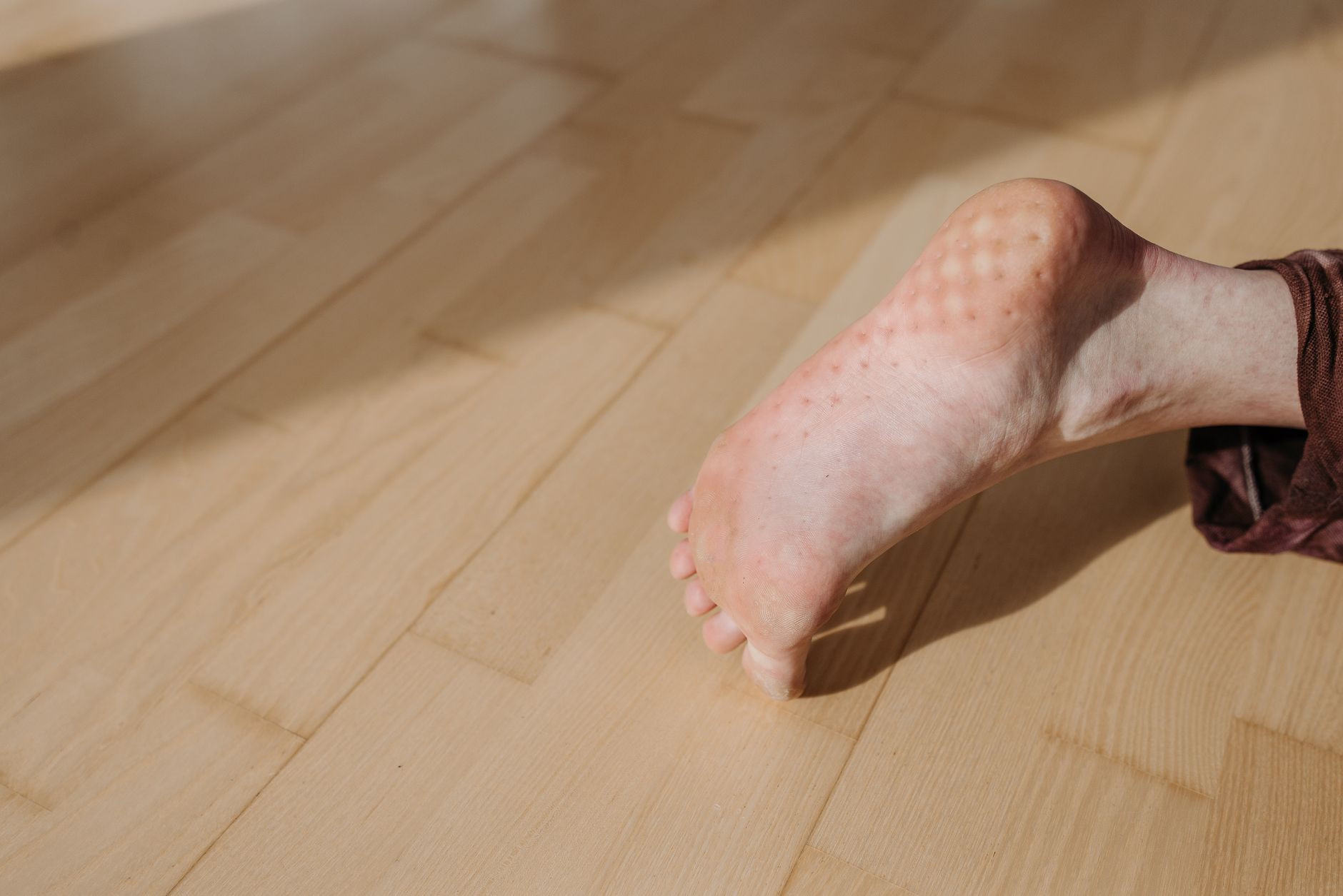 Pied creux : causes, symptômes, diagnostic et traitements