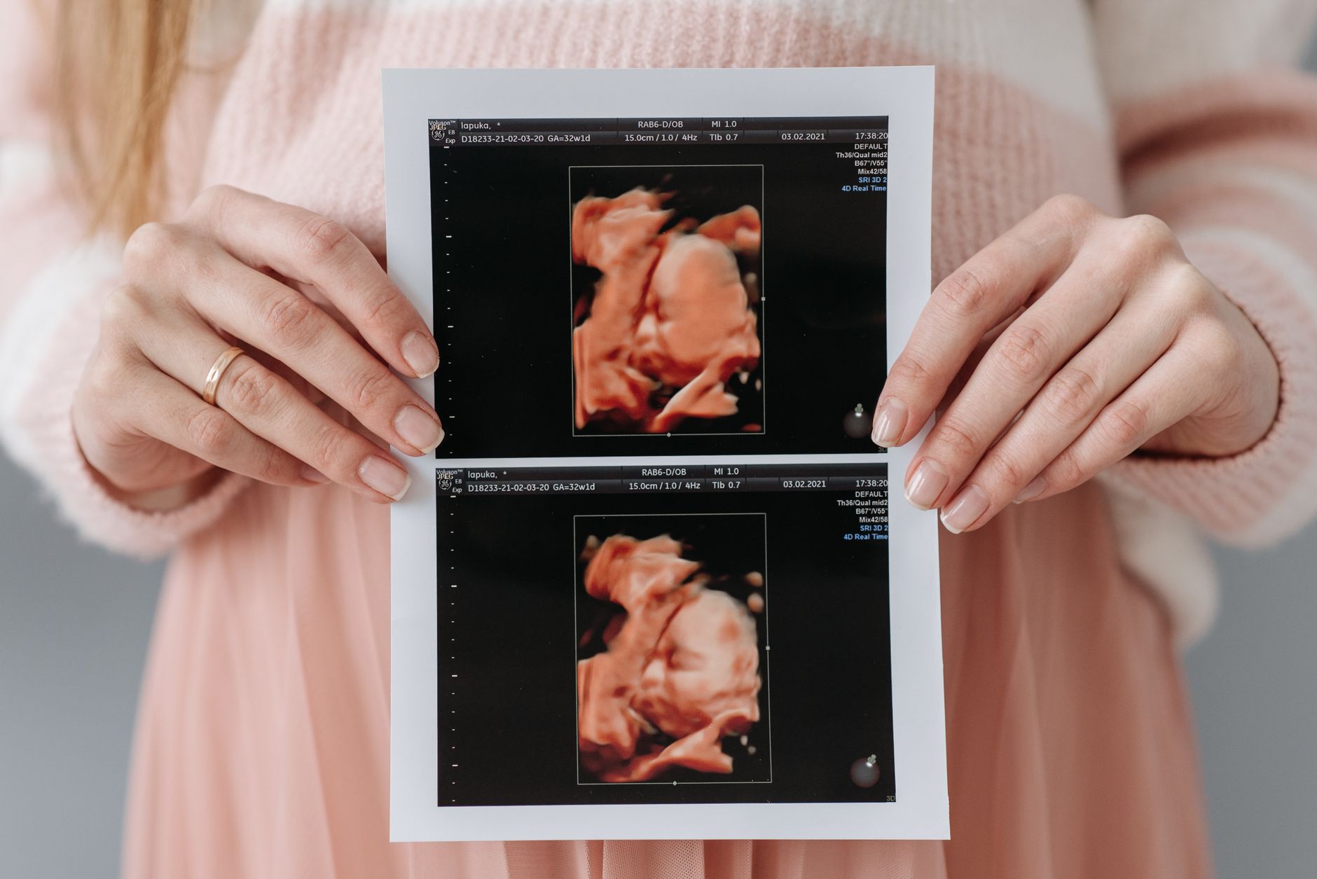 Placenta praevia : causes, symptômes, diagnostic et prise en charge