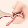 Polype des cordes vocales : causes, symptômes, diagnostic et traitements