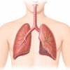 Protéinose alvéolaire pulmonaire : causes, symptômes et traitements