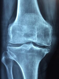 Rhumatisme psoriasique : symptômes, diagnostic et traitements