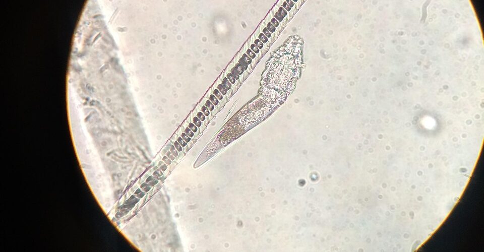 Schistosoma mansoni : comprendre la bilharziose intestinale