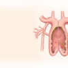Syndrome de compression de la veine cave : causes, symptômes et traitements