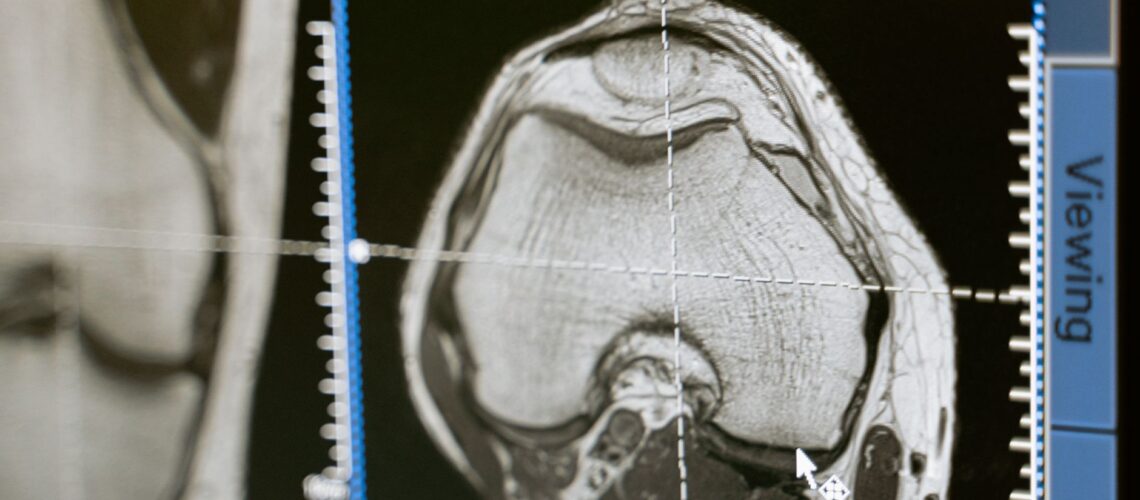 Close-up of an MRI scan displayed on a medical monitor, showcasing diagnostic medical imaging technology.