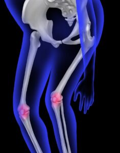 Syndrome de l'essuie-glace : causes, symptômes et traitements efficaces