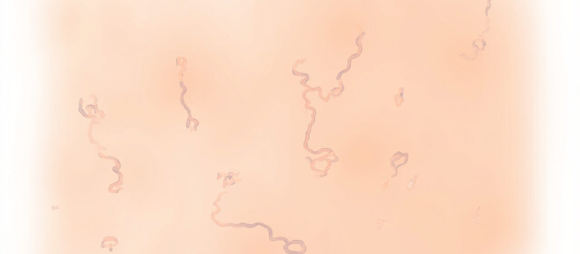 Syndrome d'épidermolyse staphylococcique : causes, symptômes et traitement