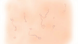 Syndrome d'épidermolyse staphylococcique : causes, symptômes et traitement