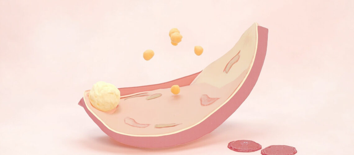 Syndrome myélodysplasique : causes, symptômes, diagnostic et traitements