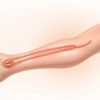 Thrombose veineuse profonde : causes, symptômes, diagnostic et traitement