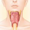 Thyroïdite de Riedel : comprendre cette fibrose thyroïdienne rare