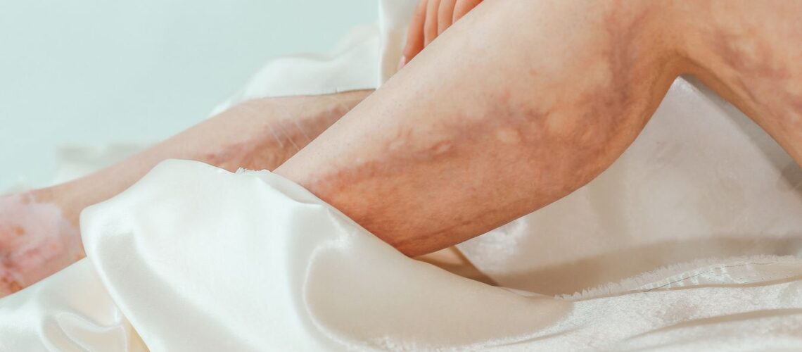A close-up view of a woman's legs with varicose veins wrapped in a luxurious satin blanket. Health and skincare concept.
