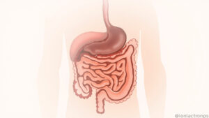 Volvulus : causes, symptômes, diagnostic et traitement