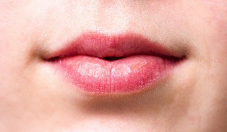 Xérostomie : comprendre, prévenir et traiter la bouche sèche