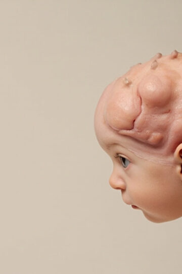 Anencéphalie : comprendre cette malformation neurologique grave