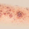 Psoriasis pustuleux : causes, formes cliniques, diagnostic et traitements