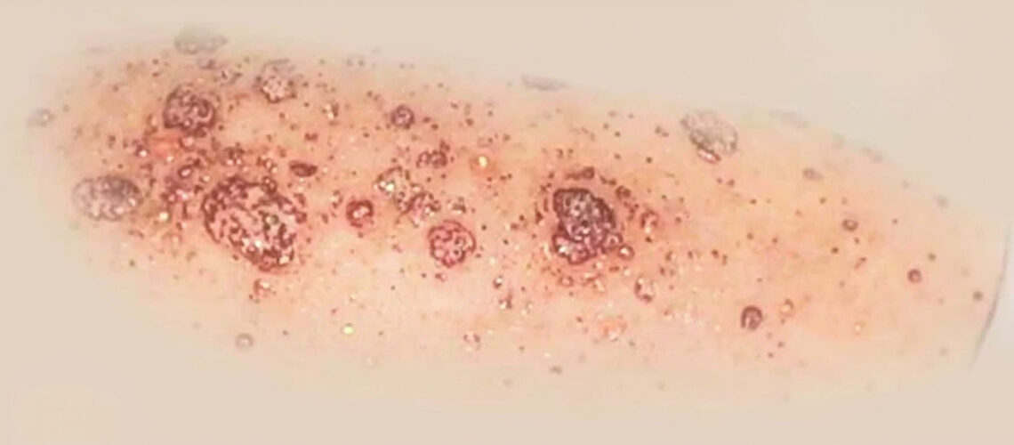 Psoriasis pustuleux : causes, formes cliniques, diagnostic et traitements