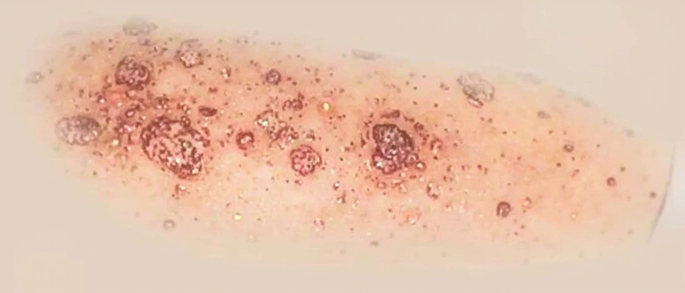 Psoriasis pustuleux : causes, formes cliniques, diagnostic et traitements