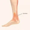 Achillodynie : causes, symptômes, diagnostic et traitement