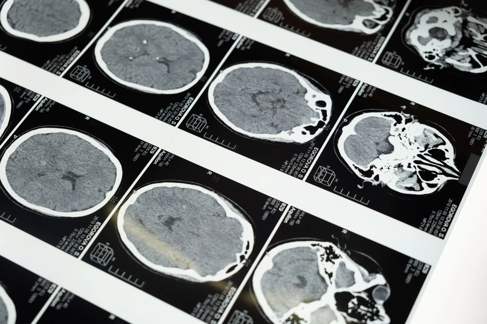 Anévrisme : causes, symptômes, diagnostic et traitements