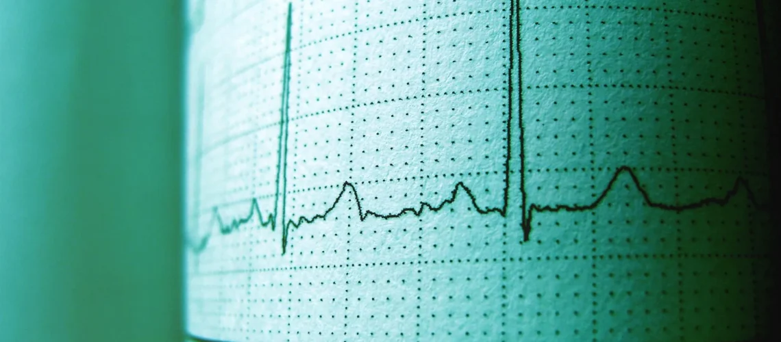 Gros plan d'un tracé d'ECG montrant le rythme et la fréquence cardiaque pour une analyse médicale.