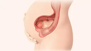 Décollement placentaire : diagnostic et prise en charge
