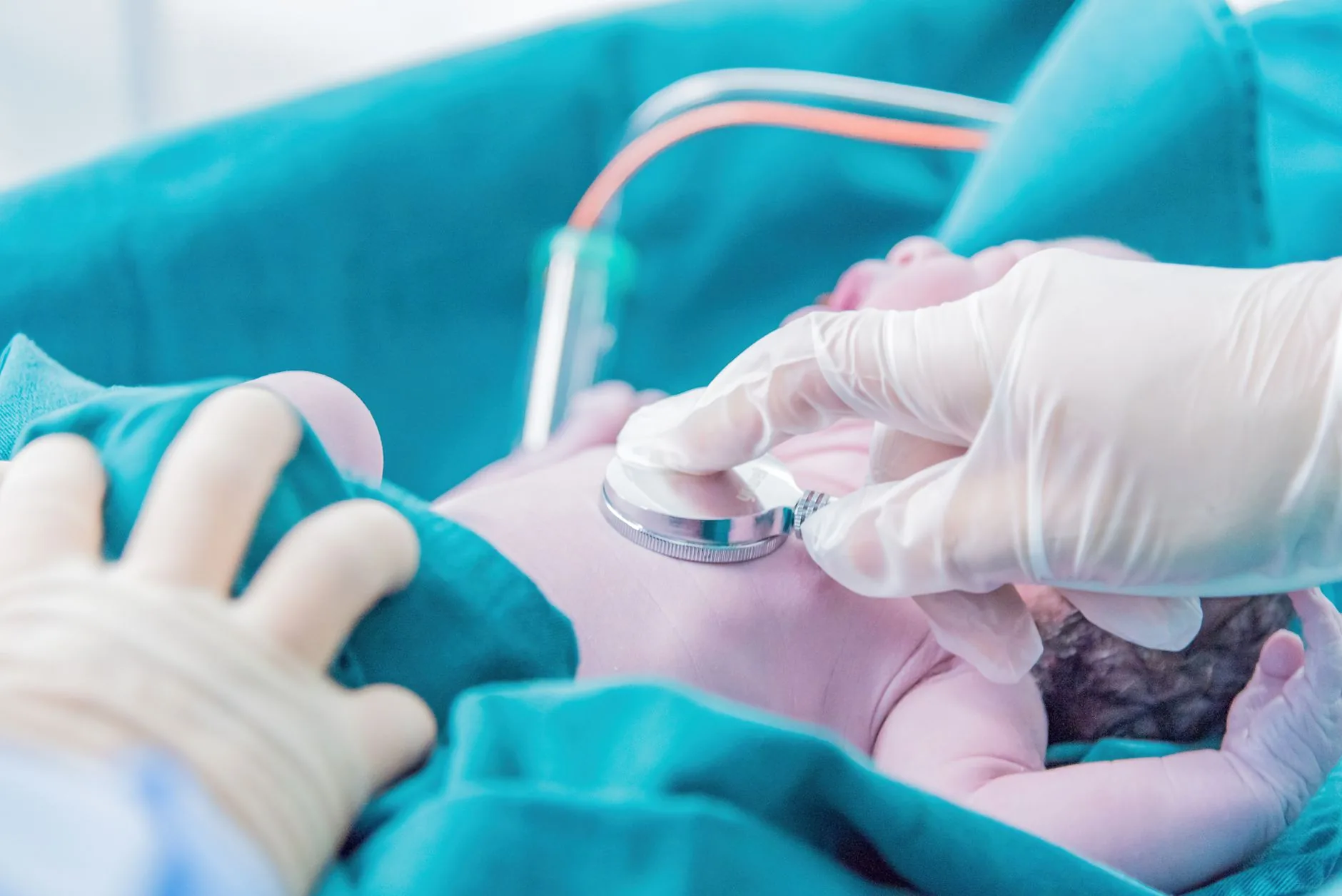 Engorgement mammaire pédiatrique : le nouveau-né