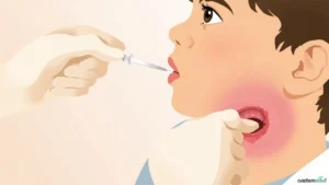 Fièvre rhumatismale : causes, traitements et prévention