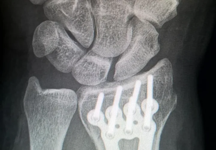 Fracture de Pouteau-Colles : causes, symptômes et traitement